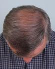 After Hair Transplant&nbsp;Front